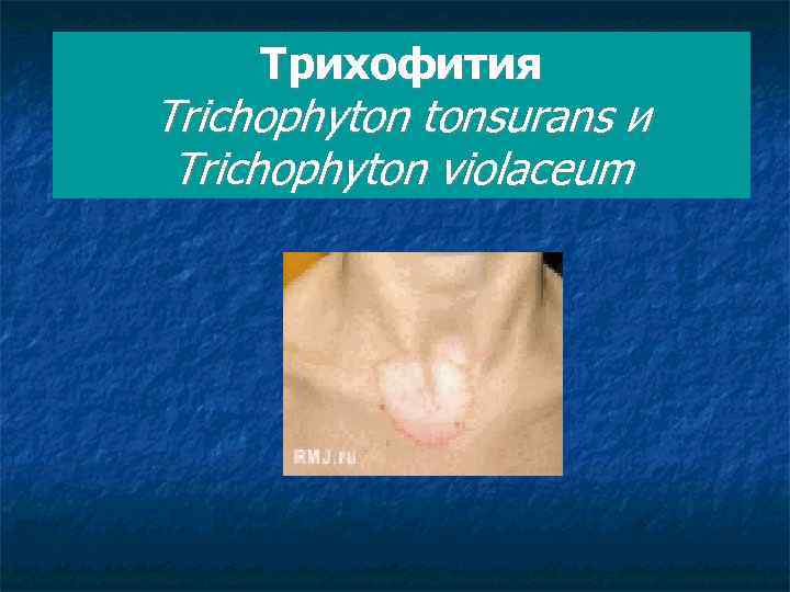 Трихофития Trichophyton tonsurans и Trichophyton violaceum 