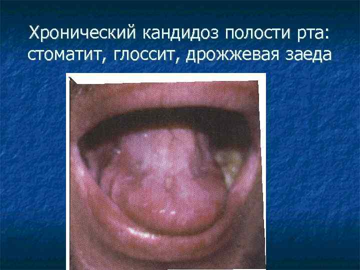 Хронический кандидоз полости рта: стоматит, глоссит, дрожжевая заеда 