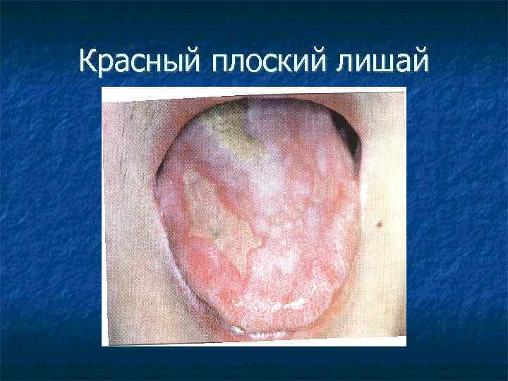 Красный плоский лишай 