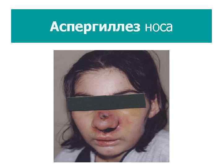 Аспергиллез носа 