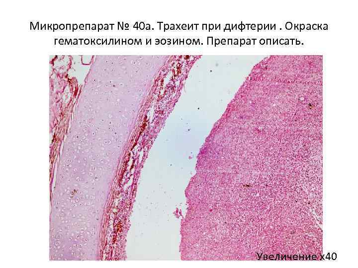 Микропрепарат № 40 а. Трахеит при дифтерии. Окраска гематоксилином и эозином. Препарат описать. Увеличение