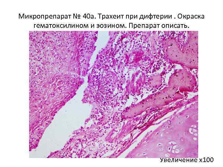Микропрепарат № 40 а. Трахеит при дифтерии. Окраска гематоксилином и эозином. Препарат описать. Увеличение