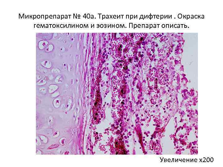 Микропрепарат № 40 а. Трахеит при дифтерии. Окраска гематоксилином и эозином. Препарат описать. Увеличение