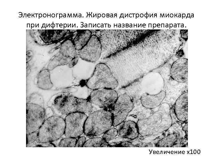 Электронограмма. Жировая дистрофия миокарда при дифтерии. Записать название препарата. Увеличение х100 