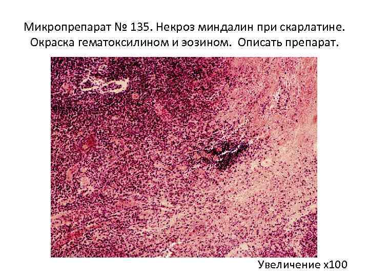 Микропрепарат № 135. Некроз миндалин при скарлатине. Окраска гематоксилином и эозином. Описать препарат. Увеличение