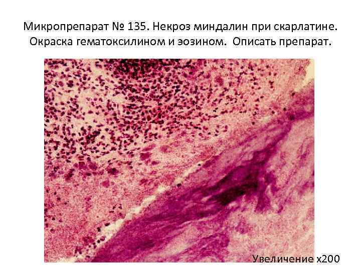 Микропрепарат № 135. Некроз миндалин при скарлатине. Окраска гематоксилином и эозином. Описать препарат. Увеличение