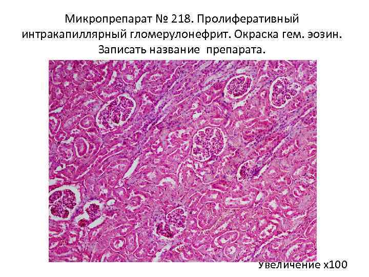 Микропрепарат № 218. Пролиферативный интракапиллярный гломерулонефрит. Окраска гем. эозин. Записать название препарата. Увеличение х100