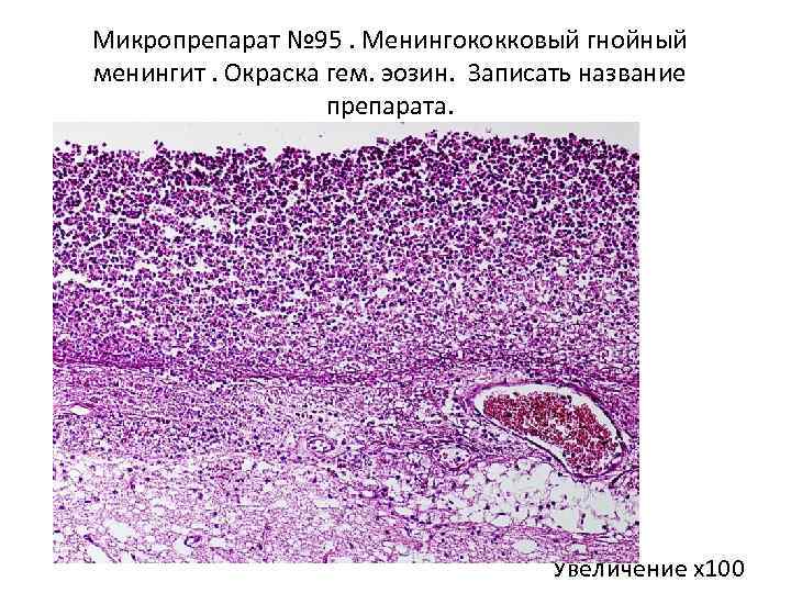 Микропрепарат № 95. Менингококковый гнойный менингит. Окраска гем. эозин. Записать название препарата. Увеличение х100