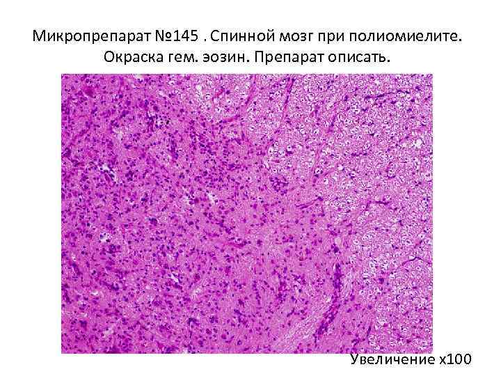 Микропрепарат № 145. Спинной мозг при полиомиелите. Окраска гем. эозин. Препарат описать. Увеличение х100