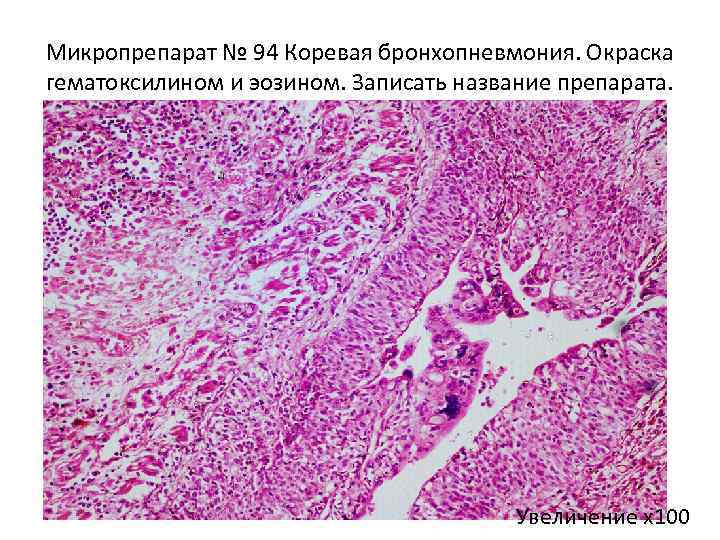Микропрепарат № 94 Коревая бронхопневмония. Окраска гематоксилином и эозином. Записать название препарата. Увеличение х100
