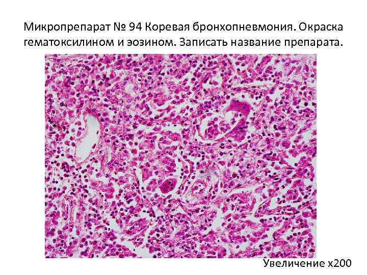 Микропрепарат № 94 Коревая бронхопневмония. Окраска гематоксилином и эозином. Записать название препарата. Увеличение х200