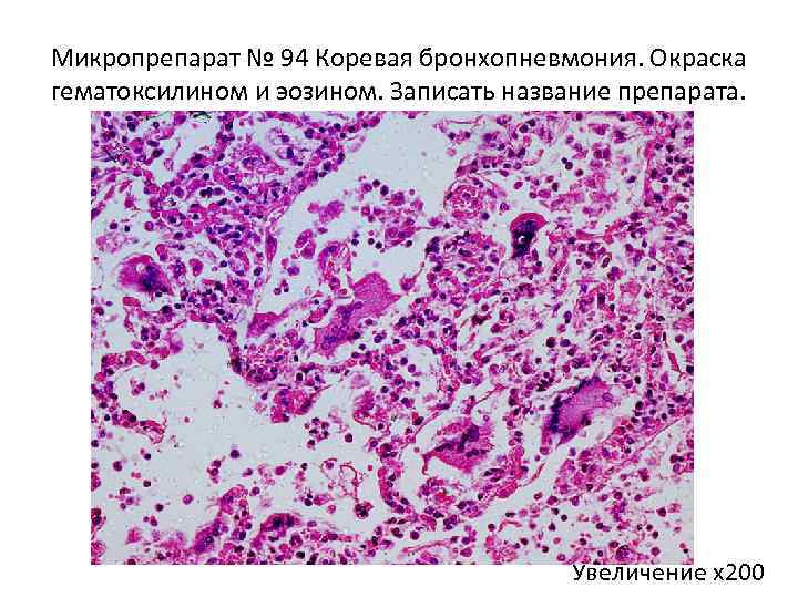 Микропрепарат № 94 Коревая бронхопневмония. Окраска гематоксилином и эозином. Записать название препарата. Увеличение х200
