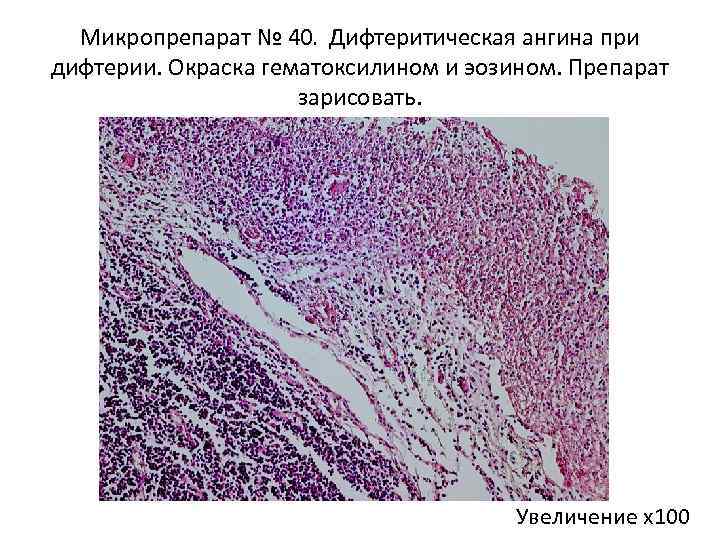 Микропрепарат № 40. Дифтеритическая ангина при дифтерии. Окраска гематоксилином и эозином. Препарат зарисовать. Увеличение