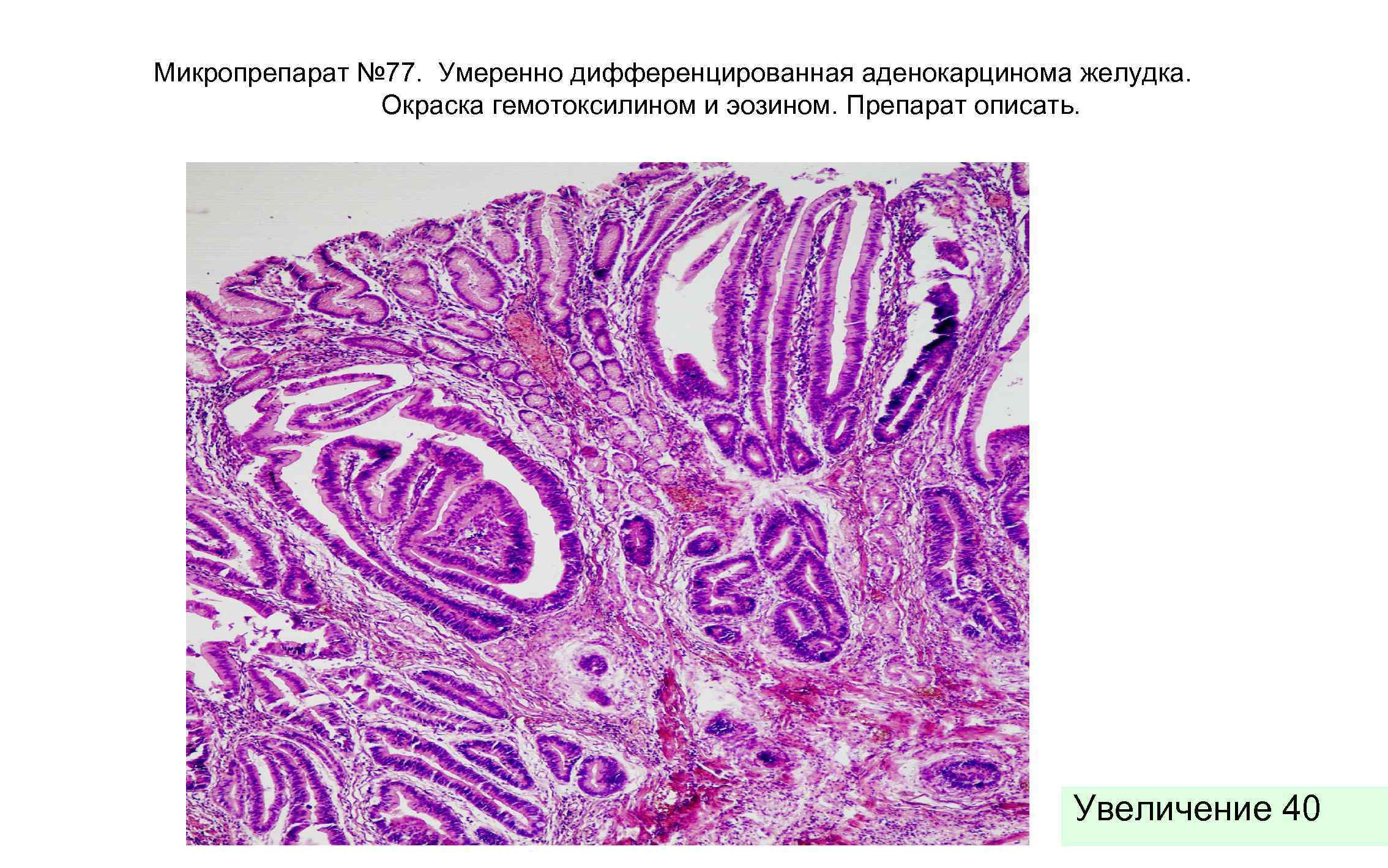 Микропрепарат № 77. Умеренно дифференцированная аденокарцинома желудка. Окраска гемотоксилином и эозином. Препарат описать. Увеличение