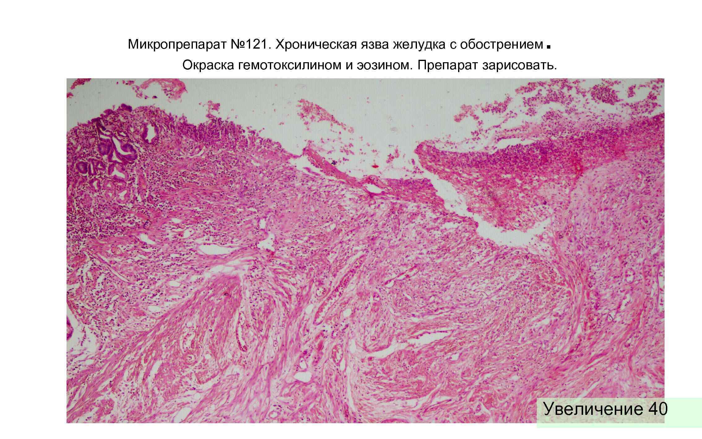 Микропрепарат № 121. Хроническая язва желудка с обострением . Окраска гемотоксилином и эозином. Препарат