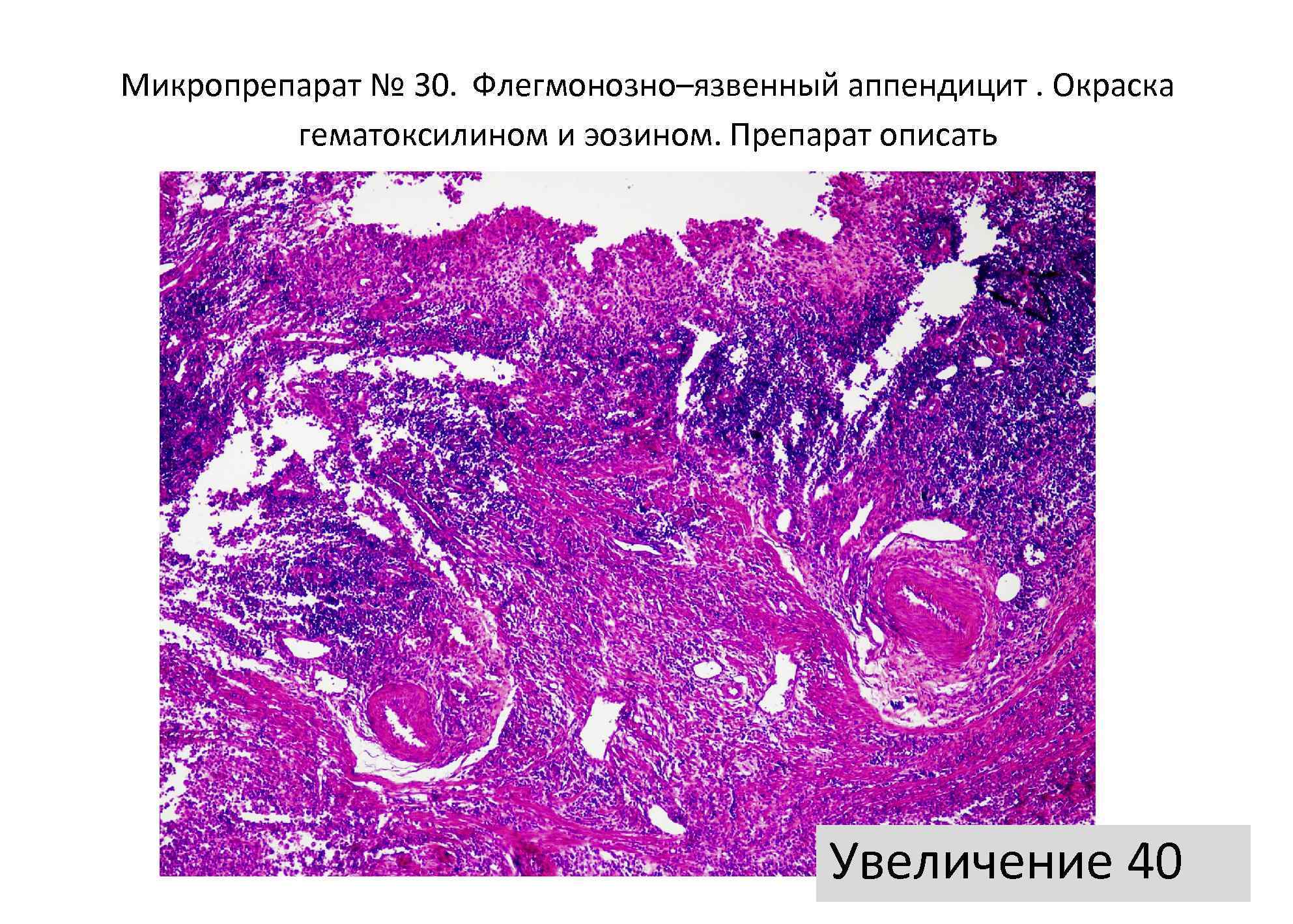 Флегмонозный аппендицит микропрепарат рисунок