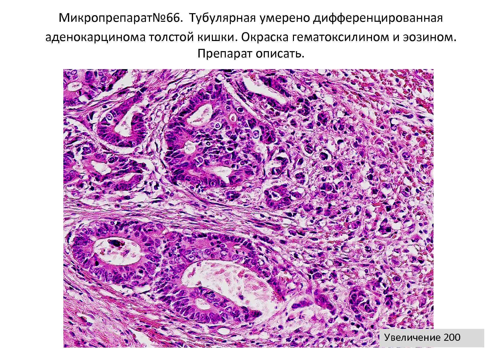 Муцинозная аденокарцинома толстой