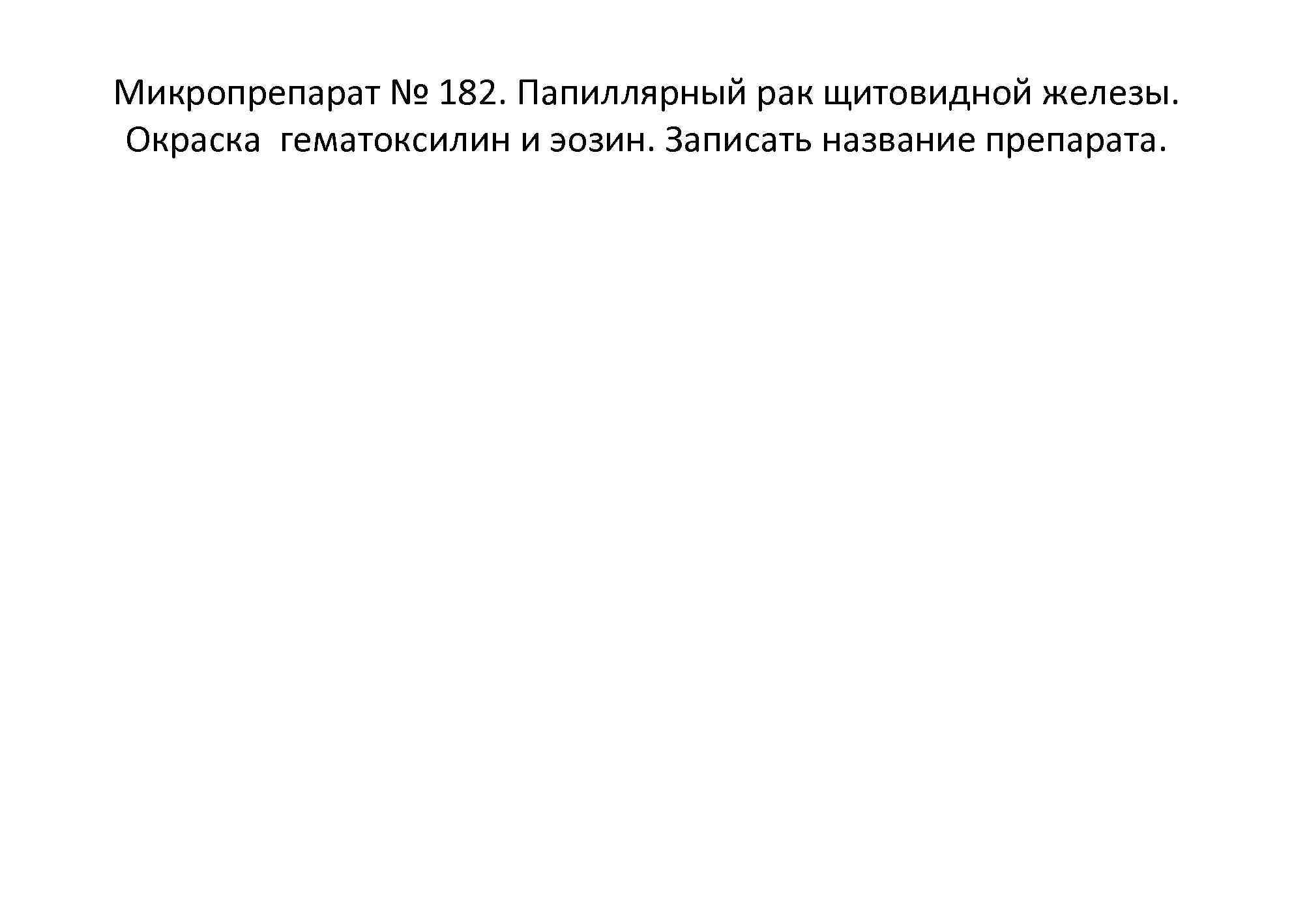 Микропрепарат № 182. Папиллярный рак щитовидной железы. Окраска гематоксилин и эозин. Записать название препарата.
