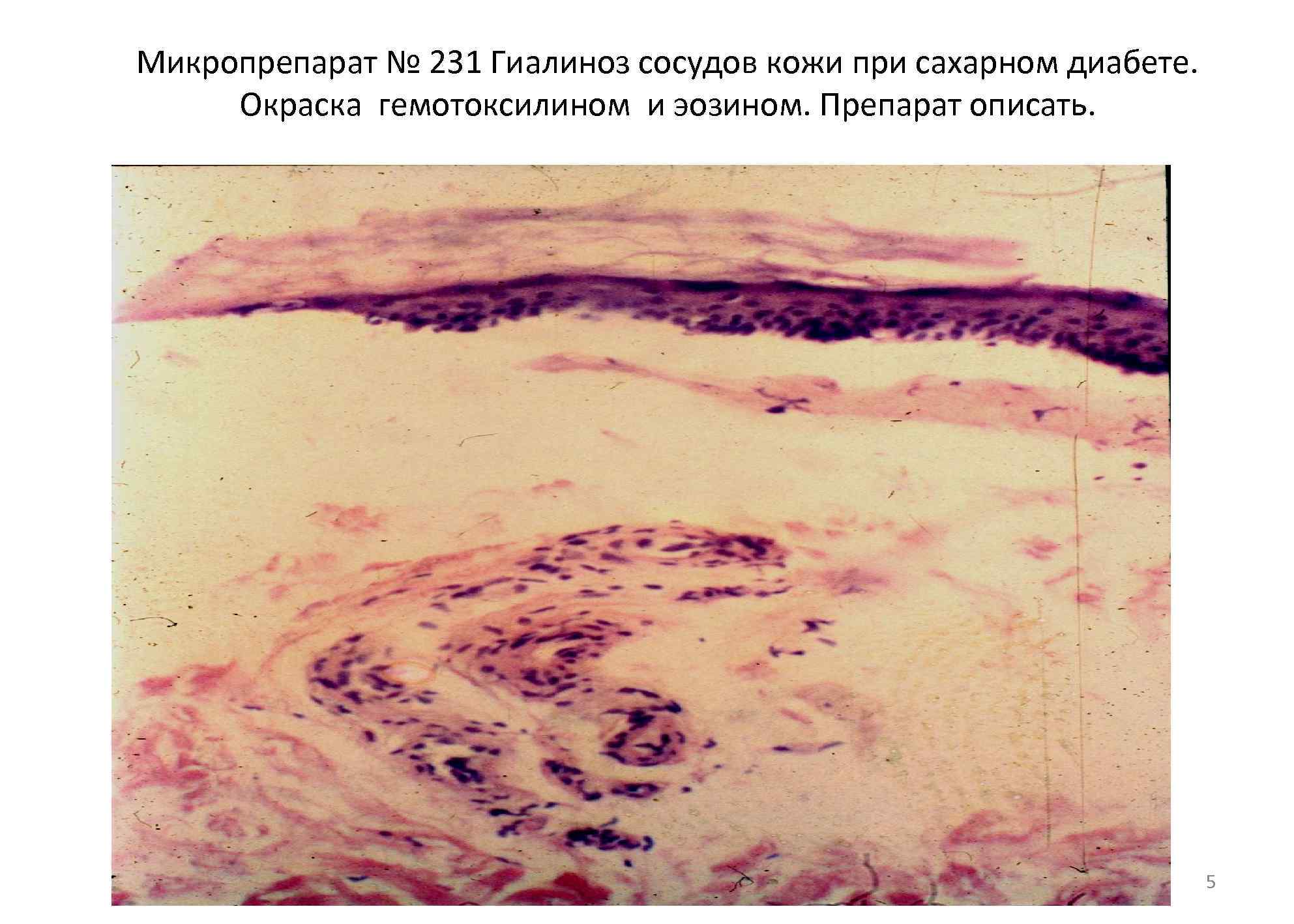 Микропрепарат № 231 Гиалиноз сосудов кожи при сахарном диабете. Окраска гемотоксилином и эозином. Препарат