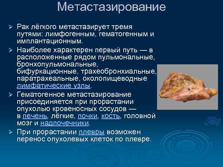 Метастазирование Рак лёгкого метастазирует тремя путями: лимфогенным, гематогенным и имплантационным. Ø Наиболее характерен первый