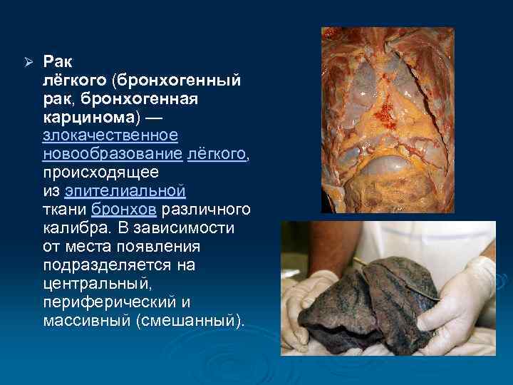 Ø Рак лёгкого (бронхогенный рак, бронхогенная карцинома) — злокачественное новообразование лёгкого, происходящее из эпителиальной