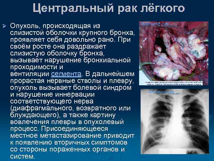 Центральный рак лёгкого Ø Опухоль, происходящая из слизистой оболочки крупного бронха, проявляет себя довольно