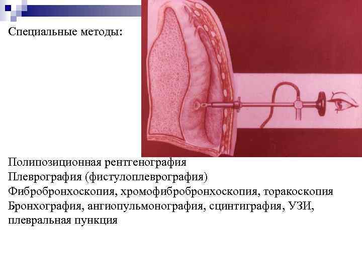 Специальные методы: Полипозиционная рентгенография Плеврография (фистулоплеврография) Фибробронхоскопия, хромофибробронхоскопия, торакоскопия Бронхография, ангиопульмонография, сцинтиграфия, УЗИ, плевральная