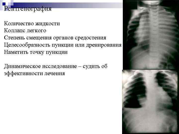 Рентгенография Количество жидкости Коллапс легкого Степень смещения органов средостения Целесообразность пункции или дренирования Наметить
