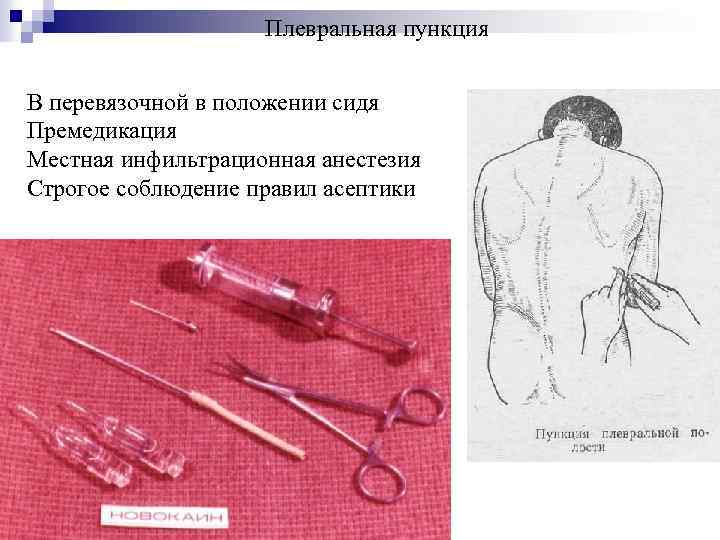 Плевральная пункция В перевязочной в положении сидя Премедикация Местная инфильтрационная анестезия Строгое соблюдение правил