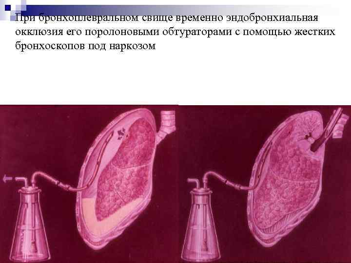 При бронхоплевральном свище временно эндобронхиальная окклюзия его поролоновыми обтураторами с помощью жестких бронхоскопов под