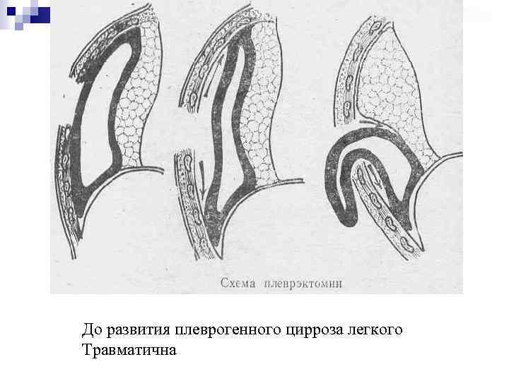 До развития плеврогенного цирроза легкого Травматична 