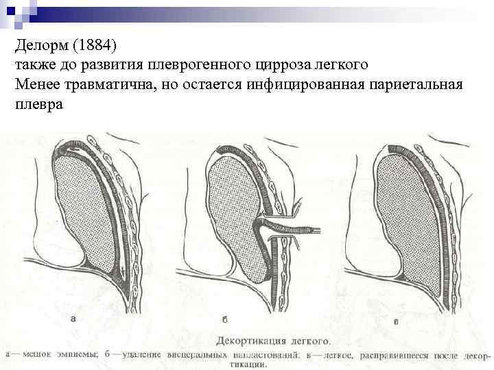 Плеврэктомия. Операция Делорма при эмпиеме плевры. Декортикация легкого при эмпиеме плевры. Декортикация легкого по Делорму. Декортикация и плеврэктомия.