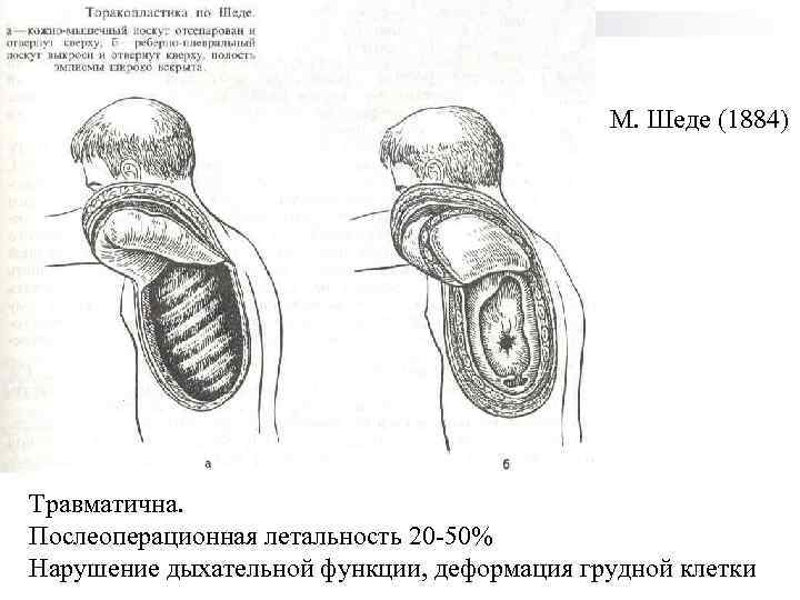 М. Шеде (1884) Травматична. Послеоперационная летальность 20 -50% Нарушение дыхательной функции, деформация грудной клетки