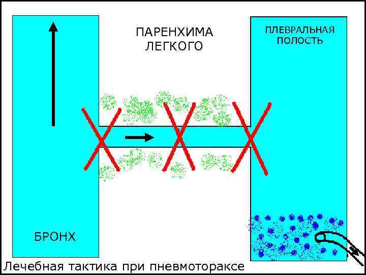 ПАРЕНХИМА ЛЕГКОГО БРОНХ Лечебная тактика при пневмотораксе ПЛЕВРАЛЬНАЯ ПОЛОСТЬ 