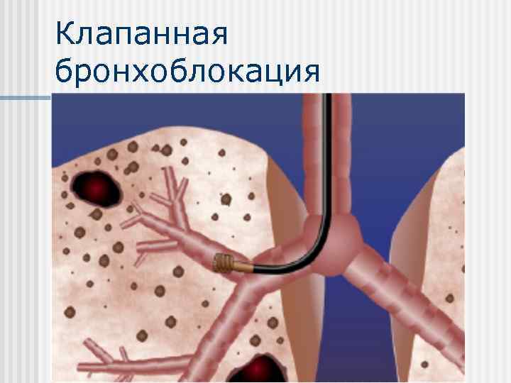 Клапанная бронхоблокация 