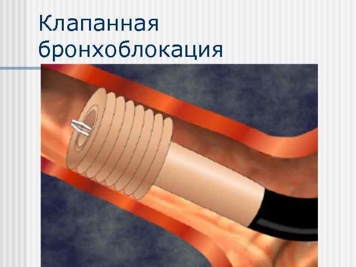 Клапанная бронхоблокация 