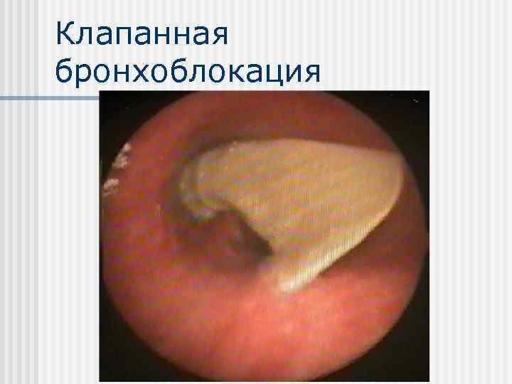 Клапанная бронхоблокация 