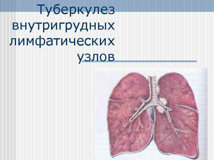 Туберкулез внутригрудных лимфатических узлов 