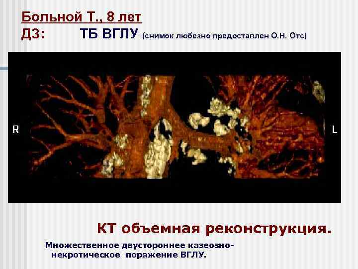 Больной Т. , 8 лет ДЗ: ТБ ВГЛУ (снимок любезно предоставлен О. Н. Отс)