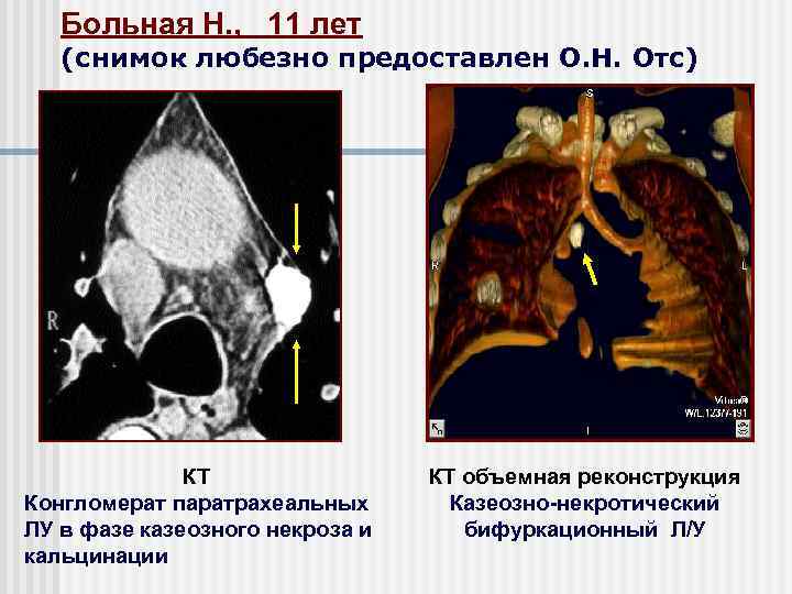 Больная Н. , 11 лет (снимок любезно предоставлен О. Н. Отс) КТ Конгломерат паратрахеальных
