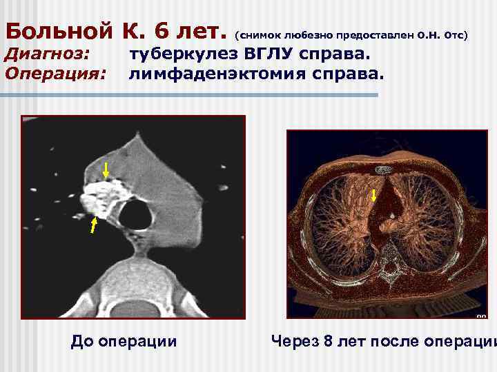 Больной К. 6 лет. Диагноз: Операция: (снимок любезно предоставлен О. Н. Отс) туберкулез ВГЛУ