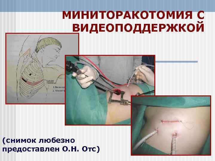 МИНИТОРАКОТОМИЯ С ВИДЕОПОДДЕРЖКОЙ (снимок любезно предоставлен О. Н. Отс) 