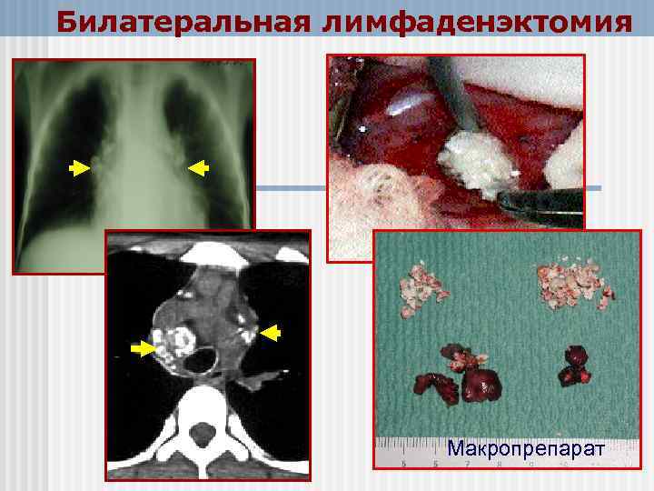Билатеральная лимфаденэктомия Макропрепарат 