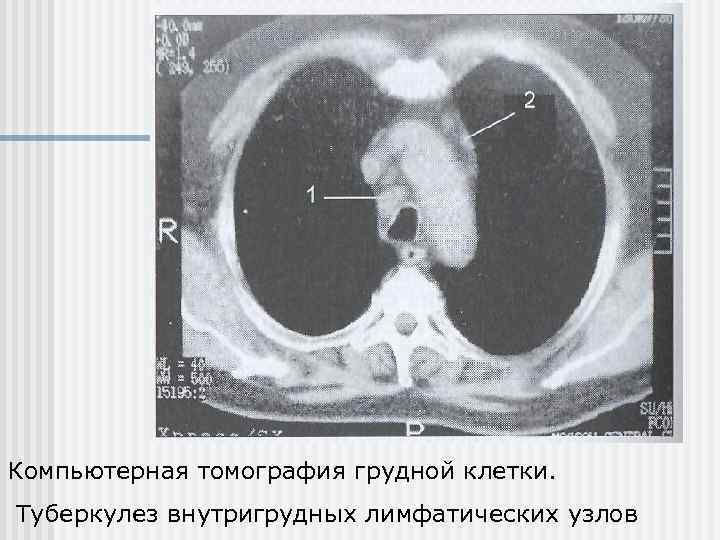 Компьютерная томография грудной клетки. Туберкулез внутригрудных лимфатических узлов 