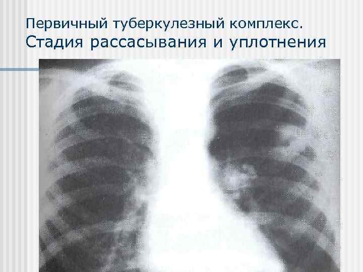 Первичный туберкулезный комплекс. Стадия рассасывания и уплотнения 