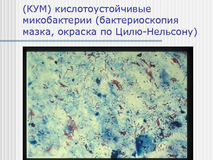 (КУМ) кислотоустойчивые микобактерии (бактериоскопия мазка, окраска по Цилю-Нельсону) 