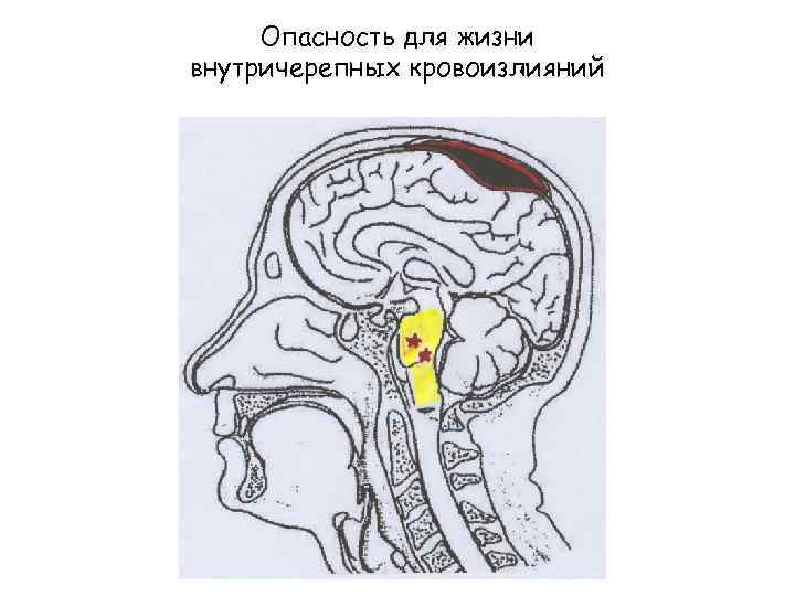 Опасность для жизни внутричерепных кровоизлияний 