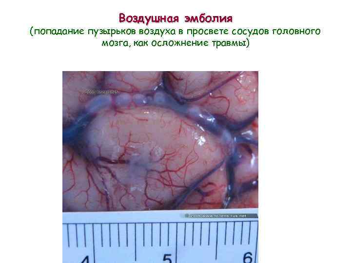 Воздушная эмболия (попадание пузырьков воздуха в просвете сосудов головного мозга, как осложнение травмы) 