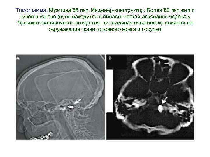Томограмма. Мужчина 85 лет. Инженер-конструктор. Более 80 лет жил с Томограмма пулей в голове