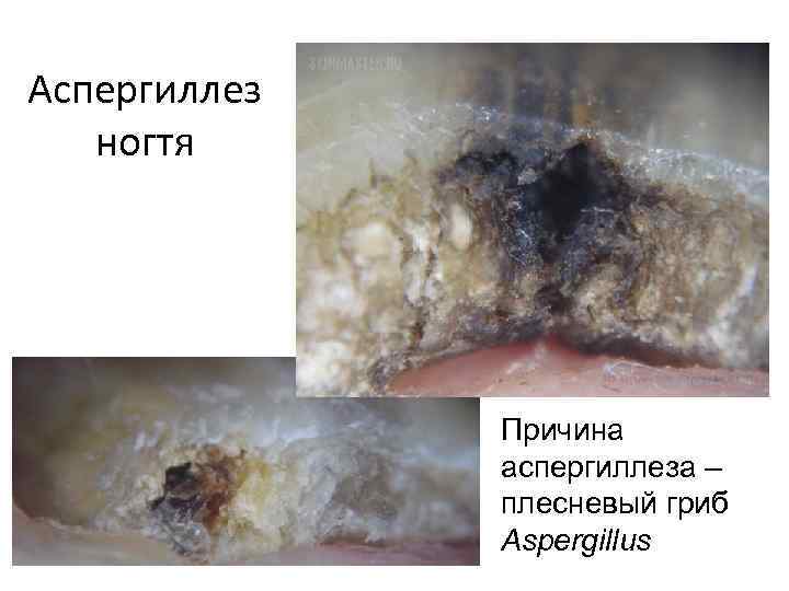 Аспергиллез ногтя Причина аспергиллеза – плесневый гриб Aspergillus 